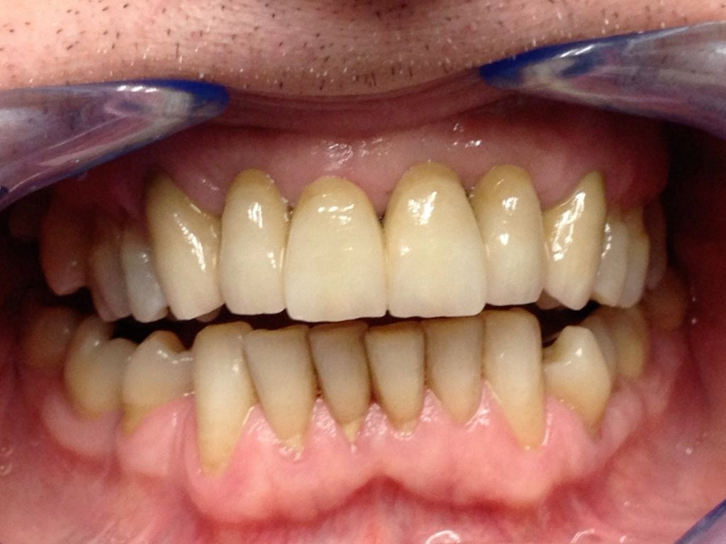 Metallo ceramiche - Dentaltre laboratorio Codroipo